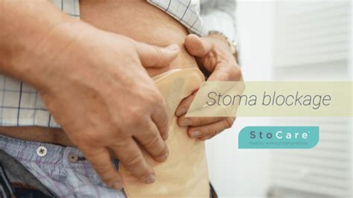 How long can a stoma blockage last?