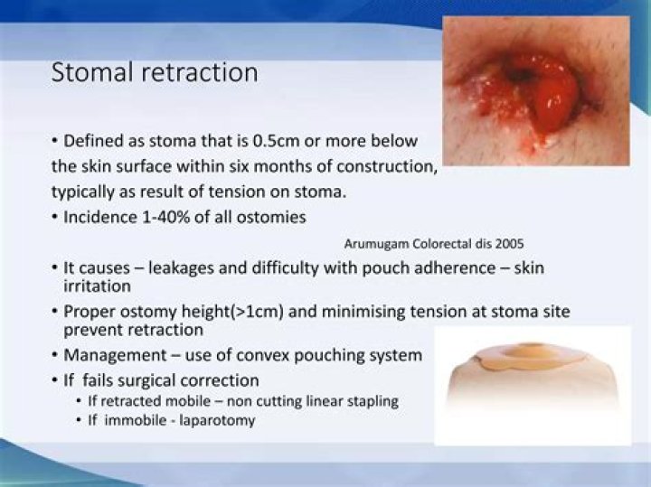 What causes stoma retraction?