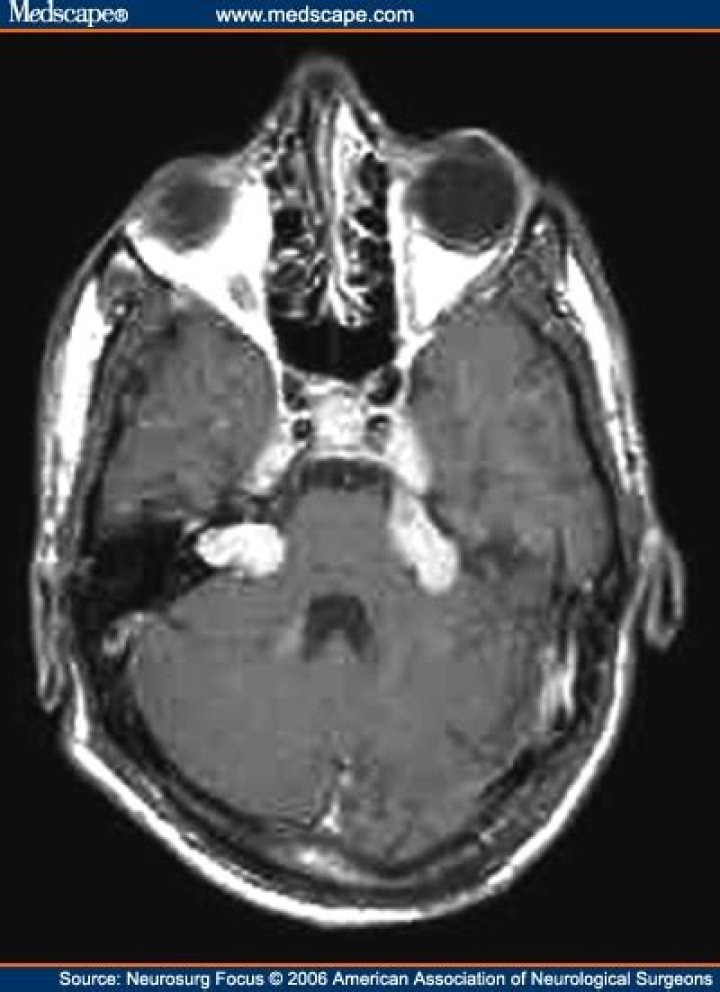 What is benign neoplasm of cranial nerves?