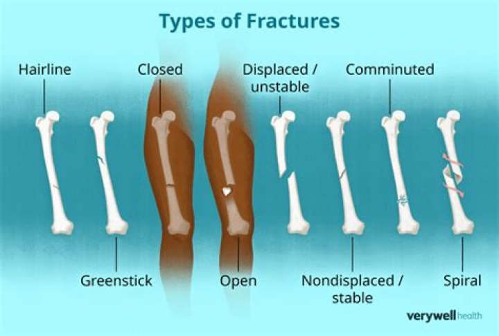 What type of fracture involves a bone breaking and splintering into pieces?